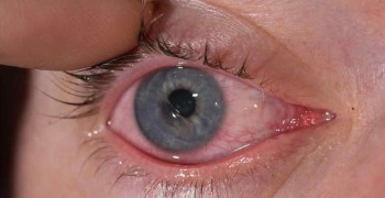 Женщине в Канаде вживили в глаз зуб для восстановления зрения