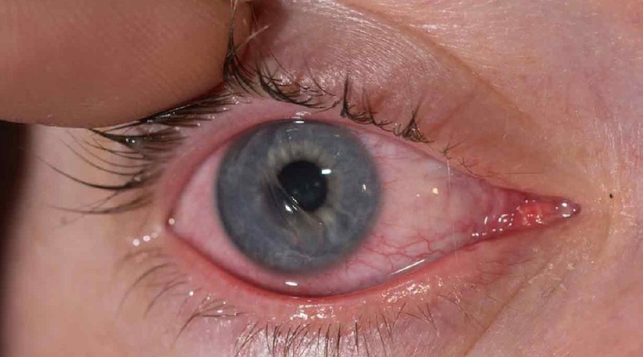 Женщине в Канаде вживили в глаз зуб для восстановления зрения